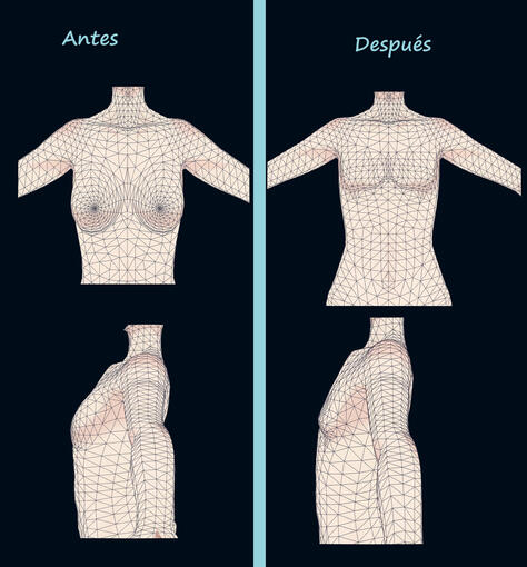 conversión del pecho de femenino a masculino.